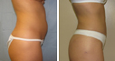 Before & After Photos